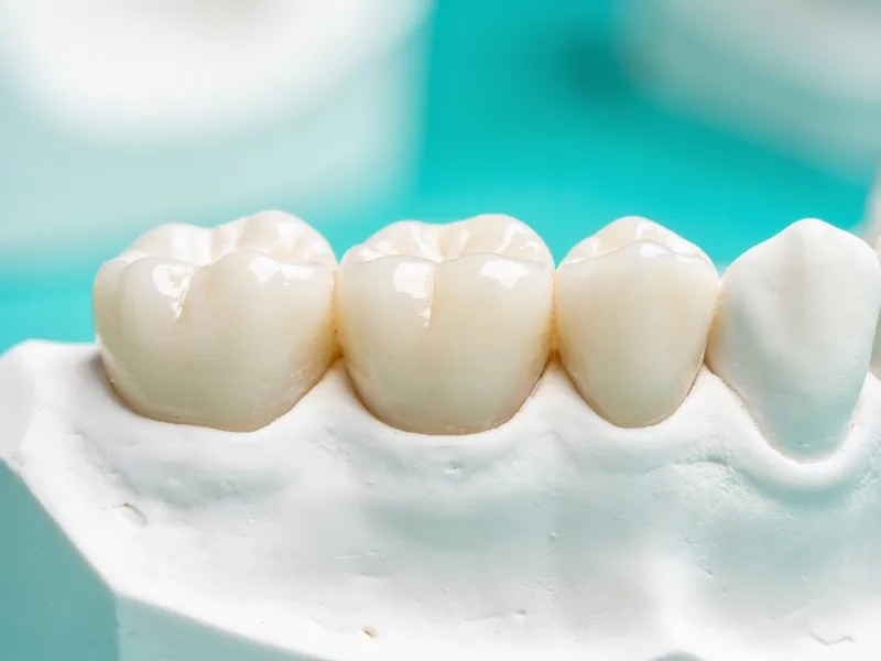 Dental Bridges