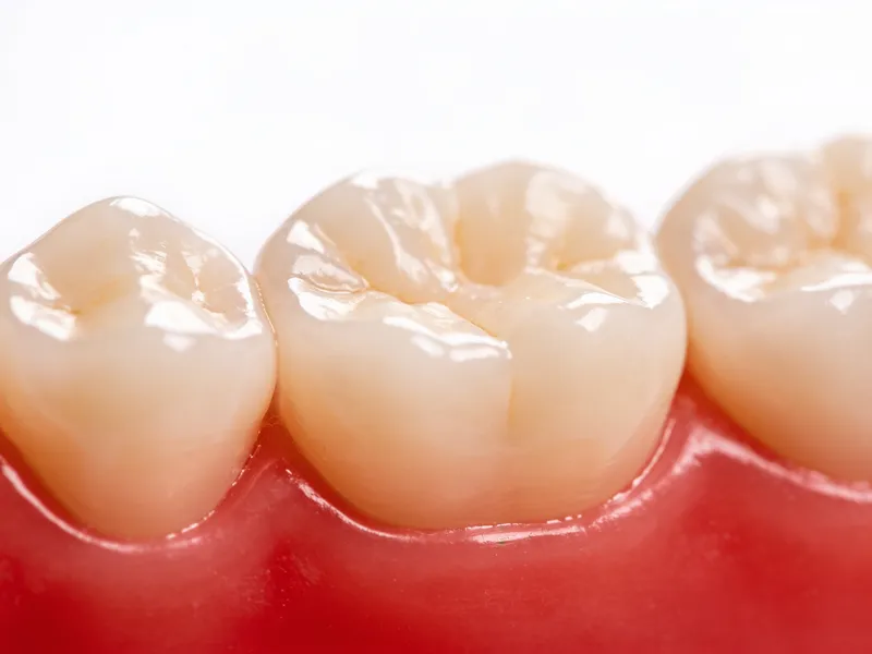 Dental Crowns