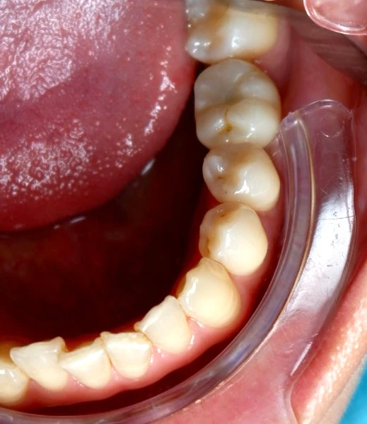 Final zirconia implant crown replacing lower left first molar tooth 36