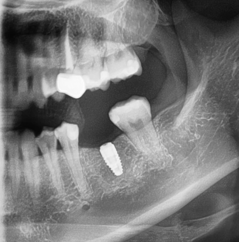 OPG showing dental implant placement at lower left first molar tooth 36