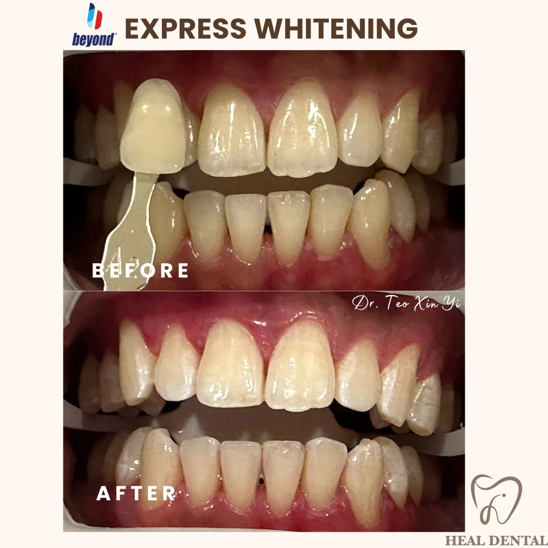 Teeth before and after Express Whitening, case EW001
