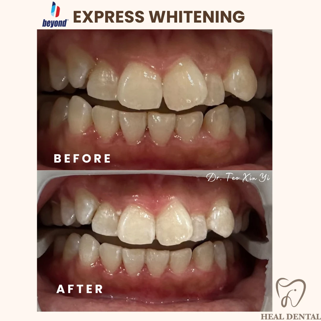 Teeth before and after Express Whitening, case EW002