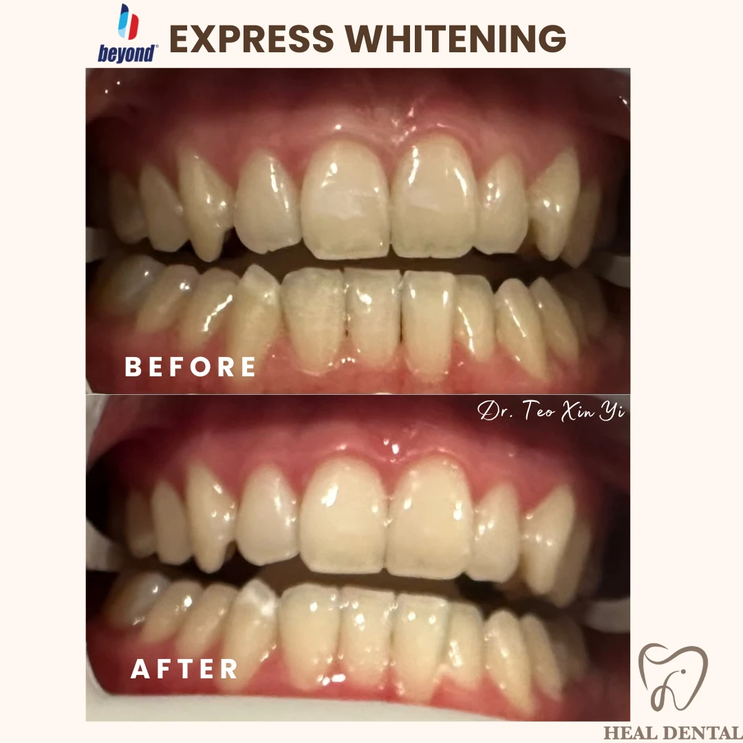 Teeth before and after Express Whitening, case EW003