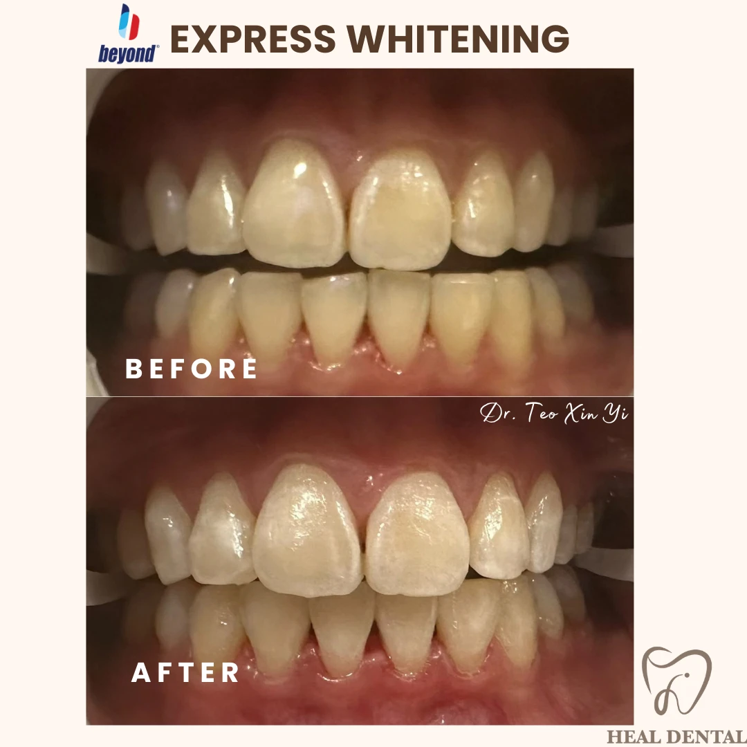 Teeth before and after Express Whitening, case EW004