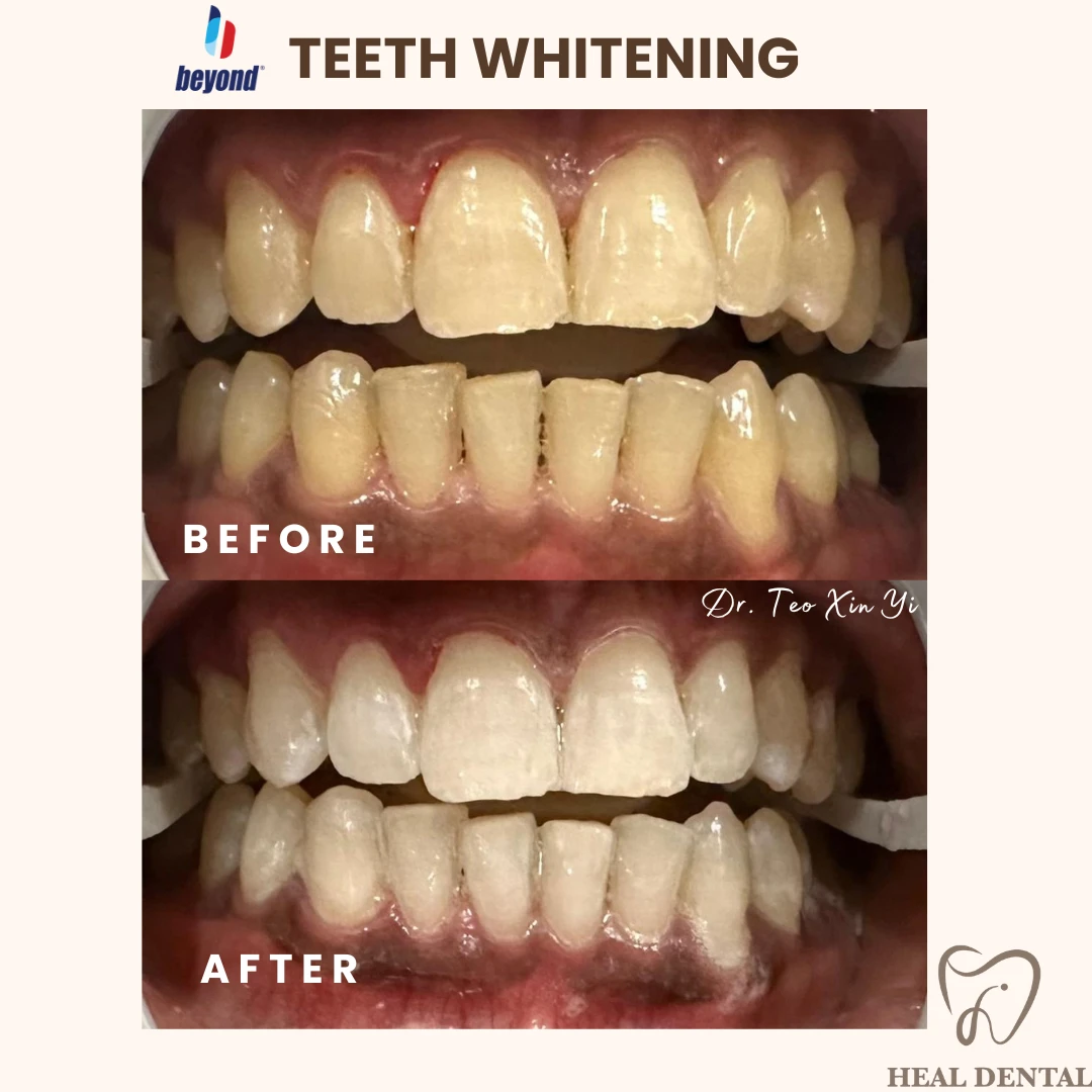 Teeth before and after Full Cycle Whitening, case TW001