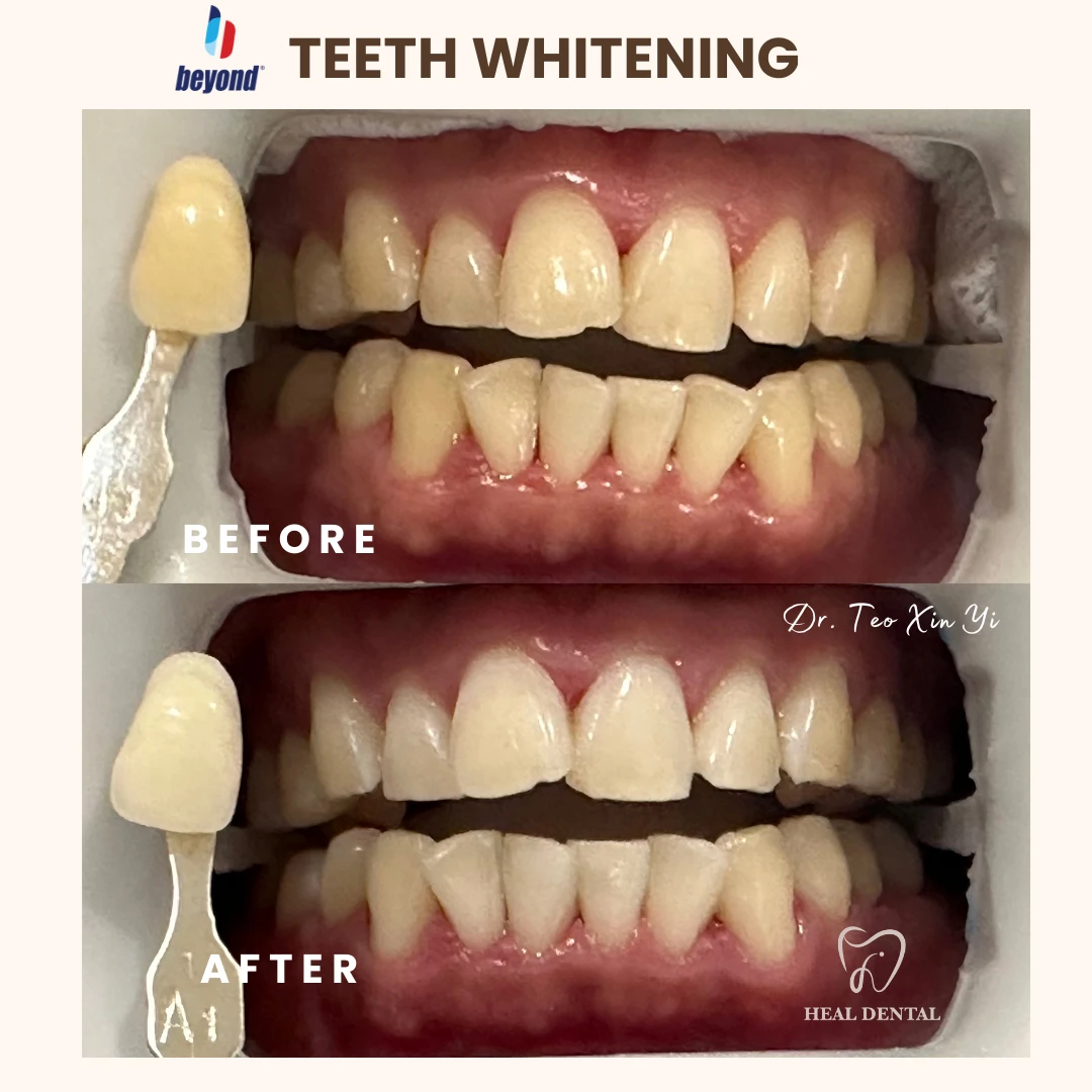 Teeth before and after Full Cycle Whitening, case TW002
