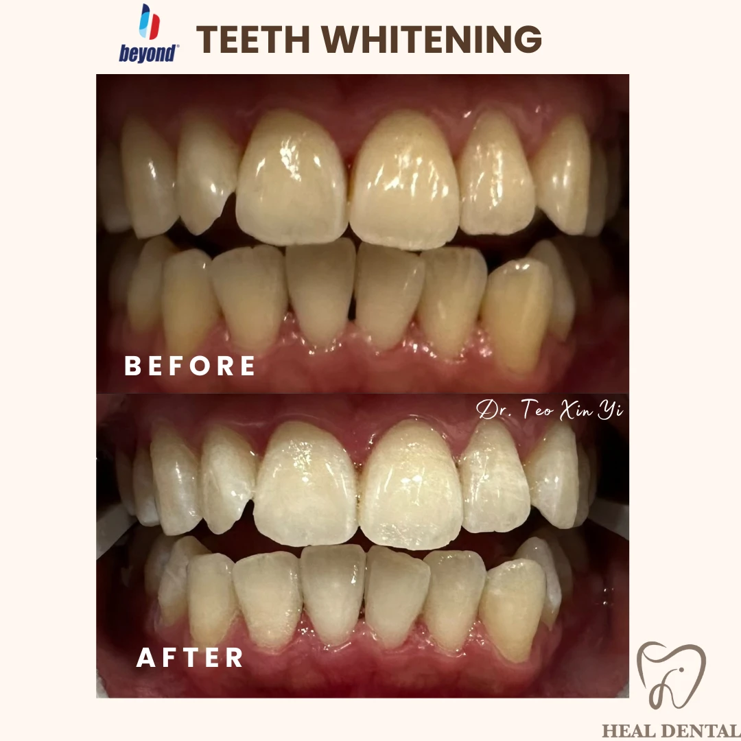 Teeth before and after Full Cycle Whitening, case TW003