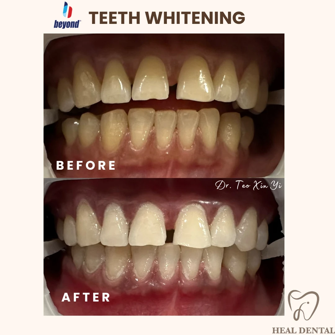 Teeth before and after Full Cycle Whitening, case TW004