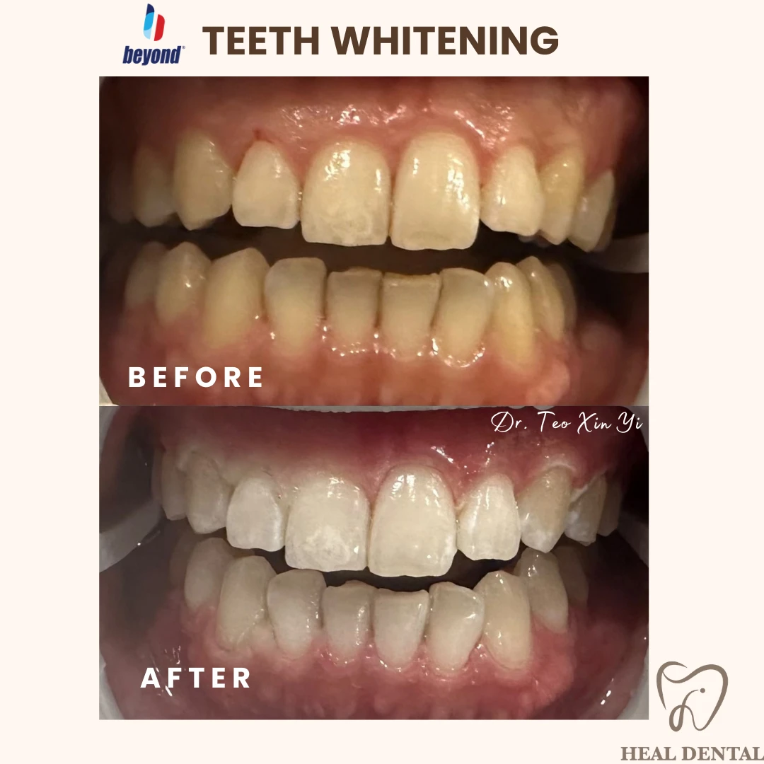 Teeth before and after Full Cycle Whitening, case TW005