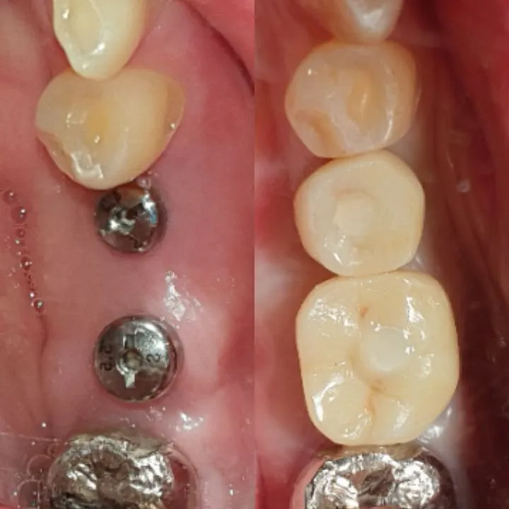 Dental implant before and after at Heal Dental Bukit Jalil, case 1