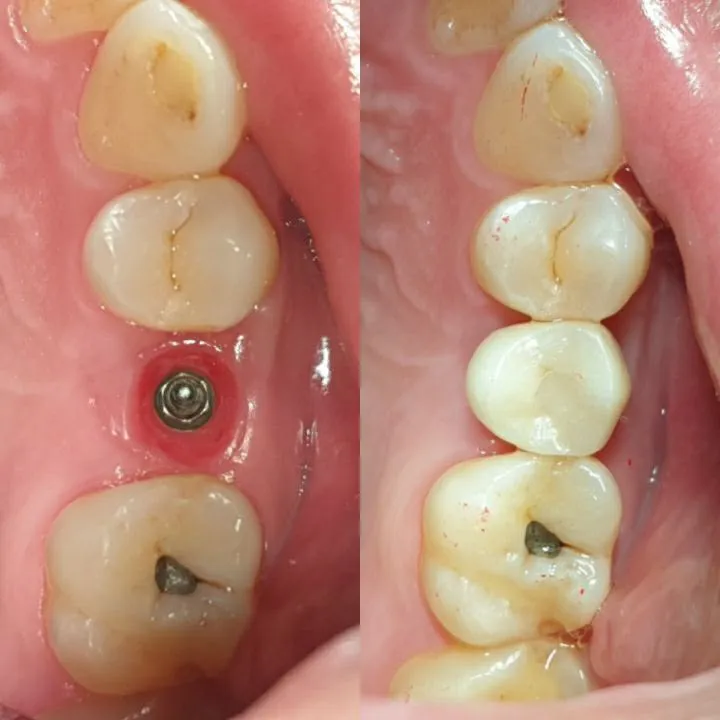 Dental implant before and after at Heal Dental Bukit Jalil, case 2