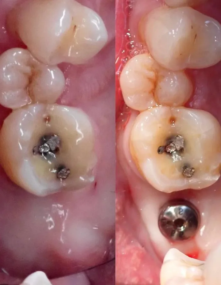 Dental implant before and after at Heal Dental Bukit Jalil, case 3