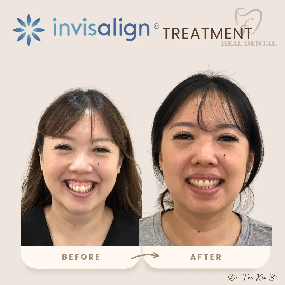 张氏牙科 Bukit Jalil 的 Invisalign 矫正前后对比，案例 1