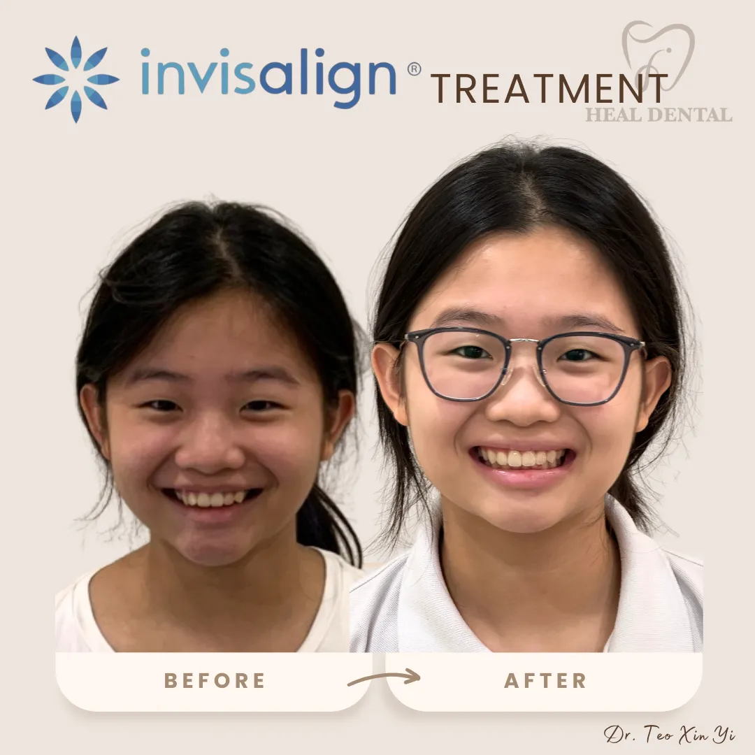 张氏牙科 Bukit Jalil 的 Invisalign 矫正前后对比，案例 2
