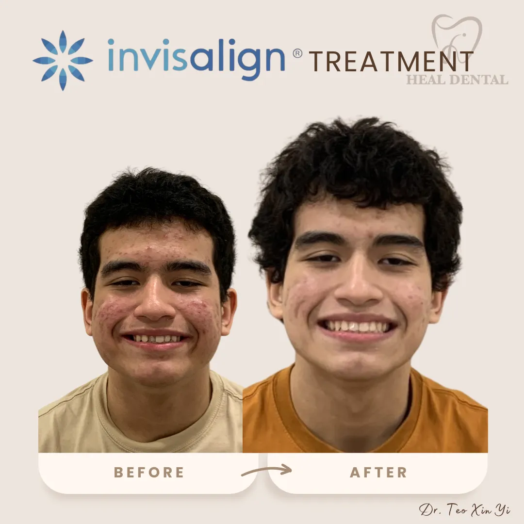 张氏牙科 Bukit Jalil 的 Invisalign 矫正前后对比，案例 3