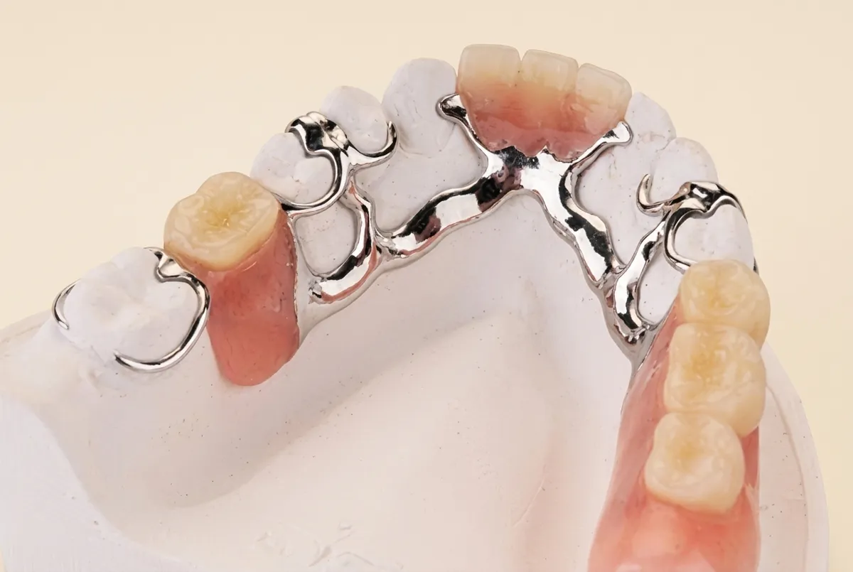 Cobalt chrome partial denture with a slim cast metal framework
