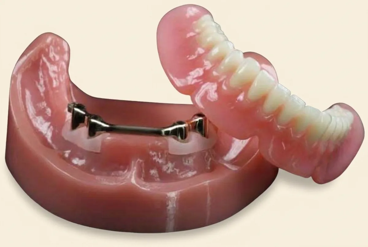 Implant-retained denture that snaps onto dental implants for a secure hold